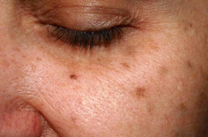 What Are Sunspots on the Skin and How Should I Treat Them?